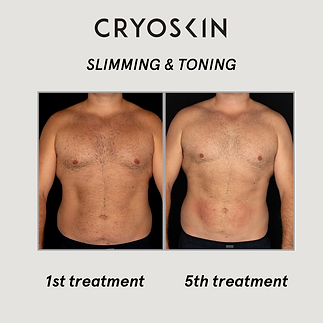 Ultrashape, Velashape, Botox | Wake Forest